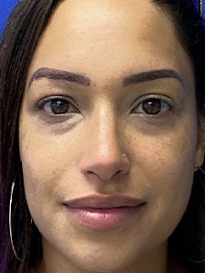 Primary Rhinoplasty Before & After Gallery - Patient 122925464 - Image 2