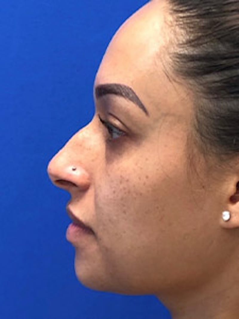 Primary Rhinoplasty Before & After Gallery - Patient 122925464 - Image 3