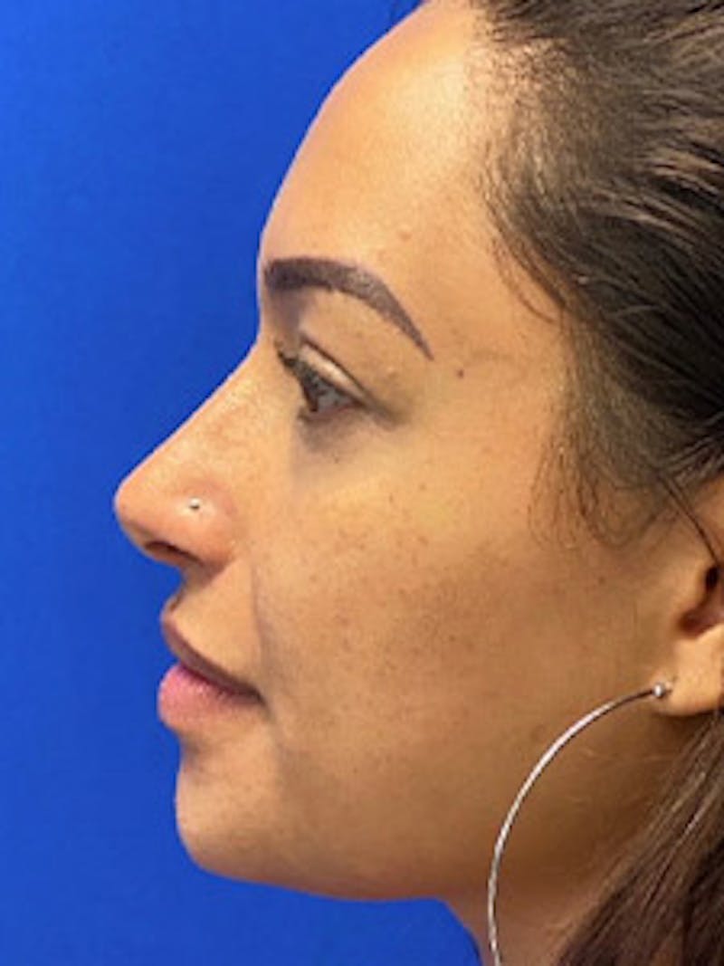 Rhinoplasty Before & After Gallery - Patient 122925464 - Image 4