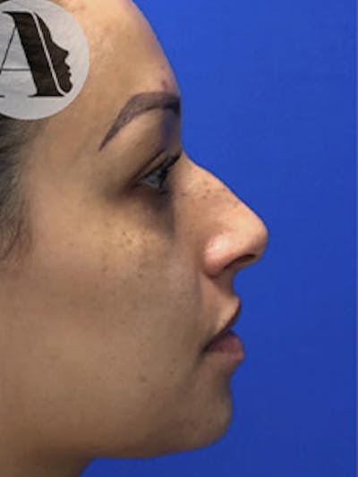 Primary Rhinoplasty Before & After Gallery - Patient 122925464 - Image 1