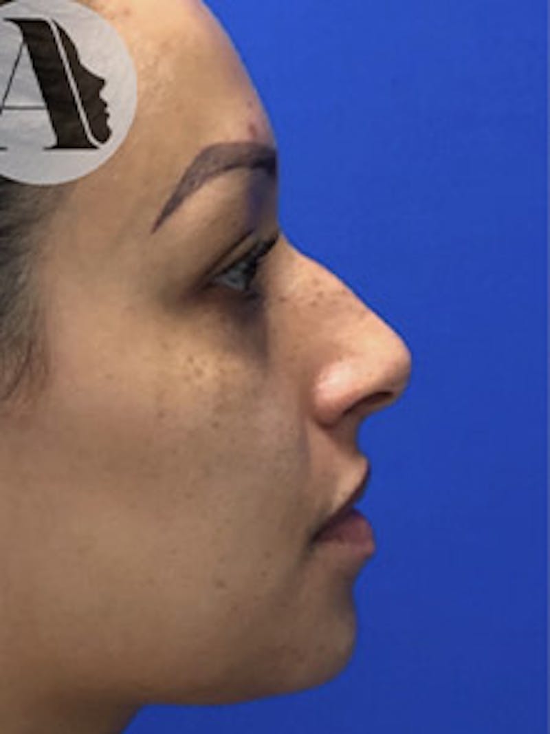 Rhinoplasty Before & After Gallery - Patient 122925464 - Image 5