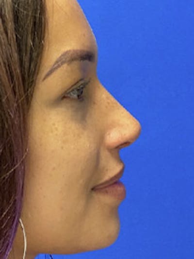 Primary Rhinoplasty Before & After Gallery - Patient 122925464 - Image 2