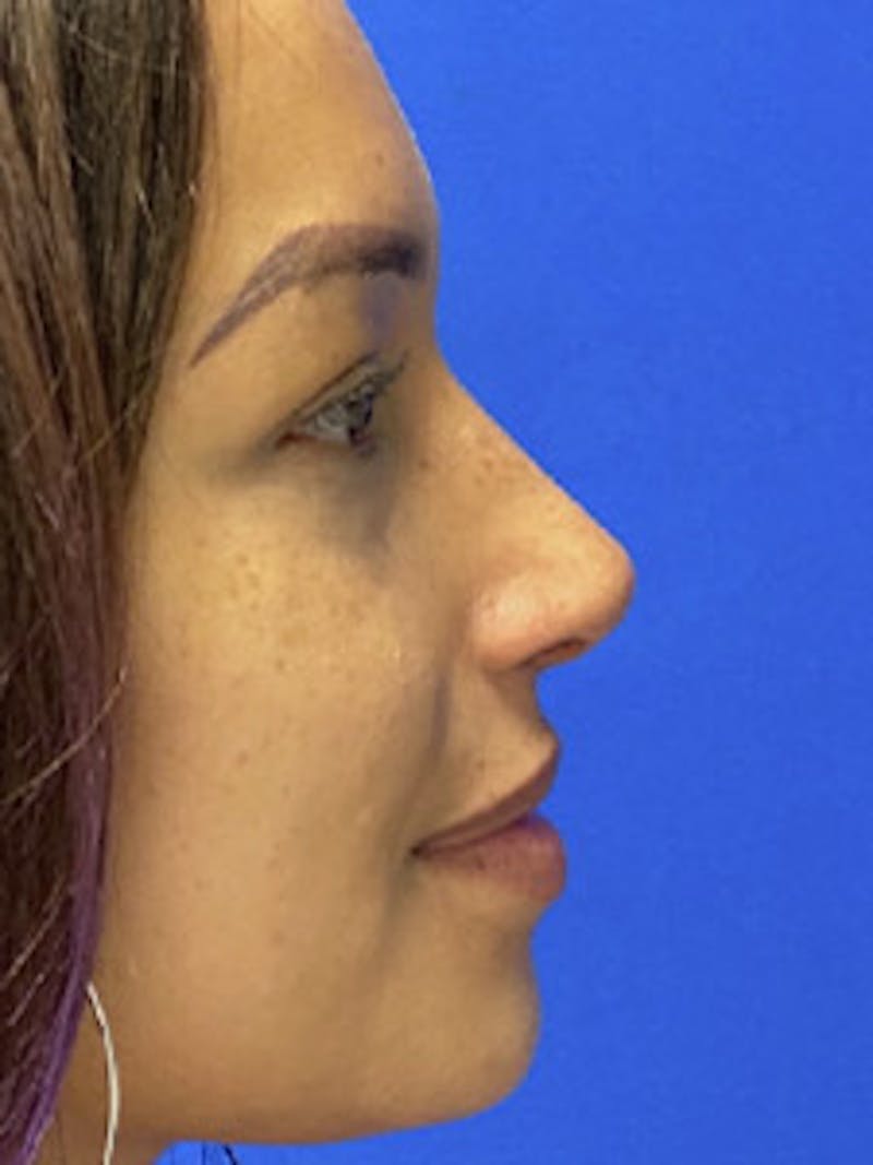 Rhinoplasty Before & After Gallery - Patient 122925464 - Image 6