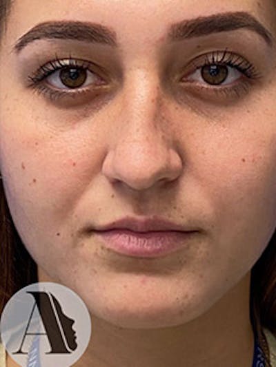 Primary Rhinoplasty Before & After Gallery - Patient 122925475 - Image 1