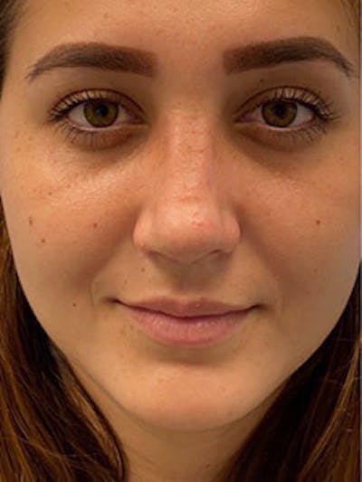 Primary Rhinoplasty Before & After Gallery - Patient 122925475 - Image 2