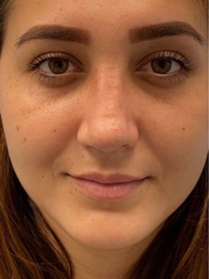 Rhinoplasty Before & After Gallery - Patient 122925475 - Image 2