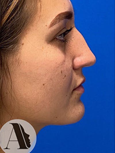 Primary Rhinoplasty Before & After Gallery - Patient 122925475 - Image 1