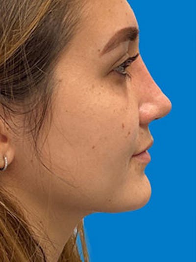 Primary Rhinoplasty Before & After Gallery - Patient 122925475 - Image 2