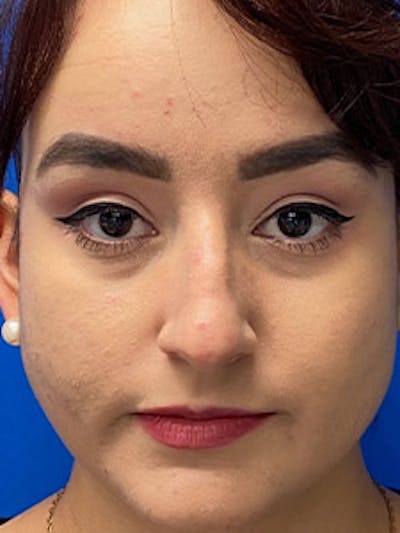 Rhinoplasty Before & After Gallery - Patient 122925488 - Image 1