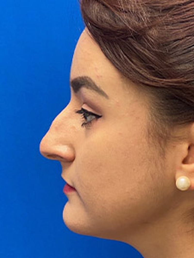 Rhinoplasty Before & After Gallery - Patient 122925488 - Image 3