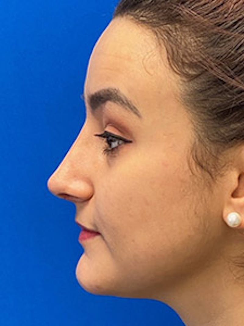 Primary Rhinoplasty Before & After Gallery - Patient 122925488 - Image 4