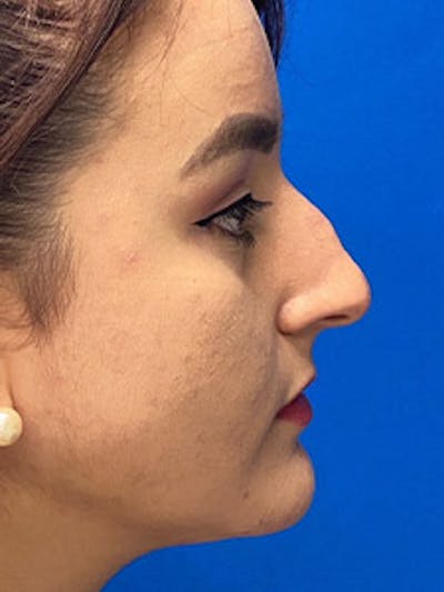 Primary Rhinoplasty Before & After Gallery - Patient 122925488 - Image 1