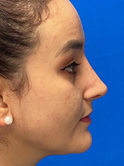 Primary Rhinoplasty Before & After Gallery - Patient 122925488 - Image 2