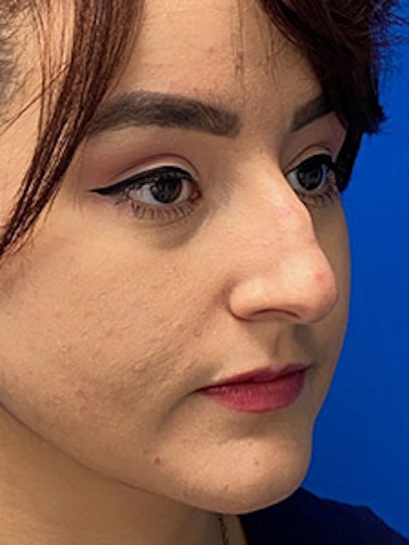 Primary Rhinoplasty Before & After Gallery - Patient 122925488 - Image 7