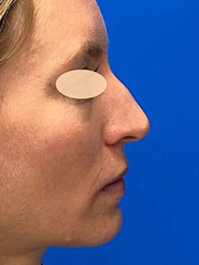 Primary Rhinoplasty Before & After Gallery - Patient 122925504 - Image 1