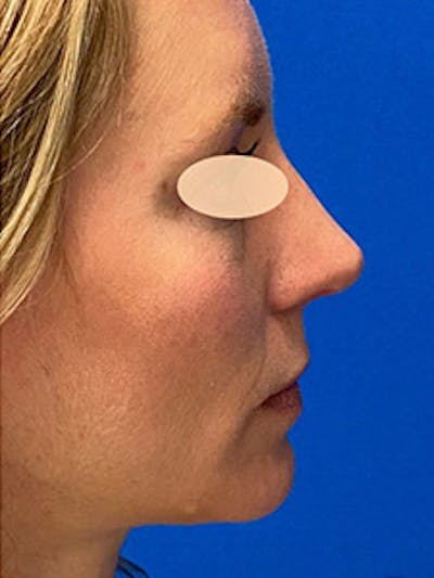 Primary Rhinoplasty Before & After Gallery - Patient 122925504 - Image 2