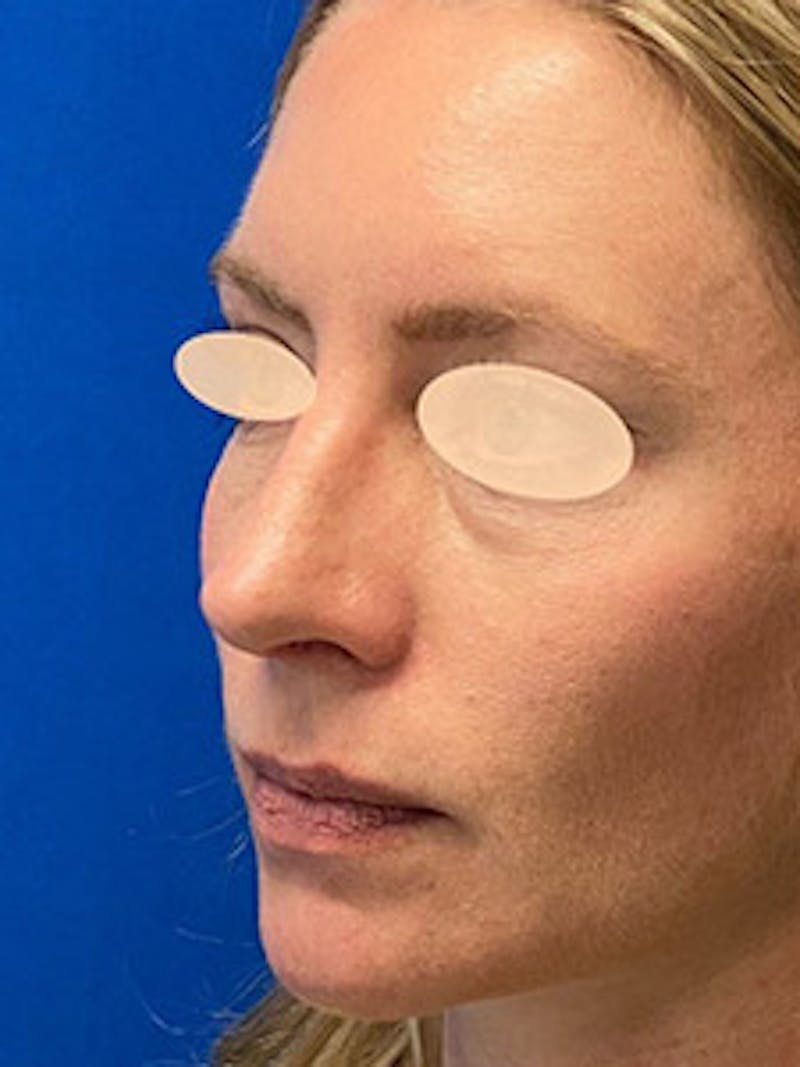 Primary Rhinoplasty Before & After Gallery - Patient 122925504 - Image 6
