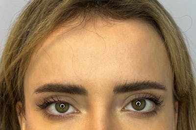 BOTOX Before & After Gallery - Patient 122929731 - Image 1