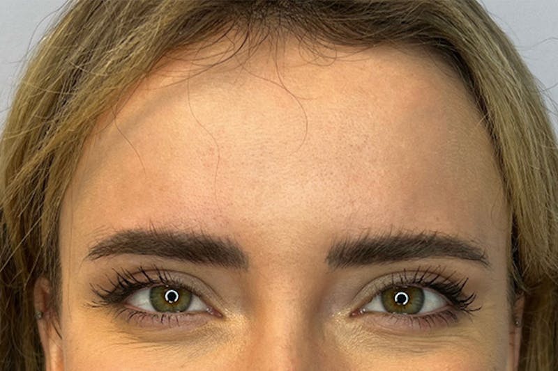 BOTOX Before & After Gallery - Patient 122929731 - Image 5