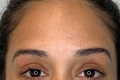 BOTOX Before & After Gallery - Patient 122929742 - Image 2