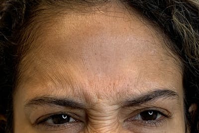 BOTOX Before & After Gallery - Patient 122929780 - Image 1