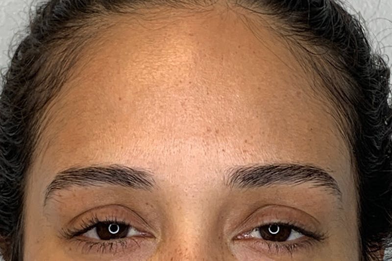 BOTOX Before & After Gallery - Patient 122929780 - Image 2