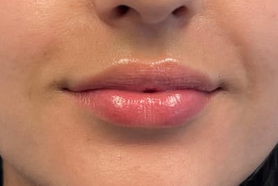 Lip Filler Before & After Gallery - Patient 122948833 - Image 1