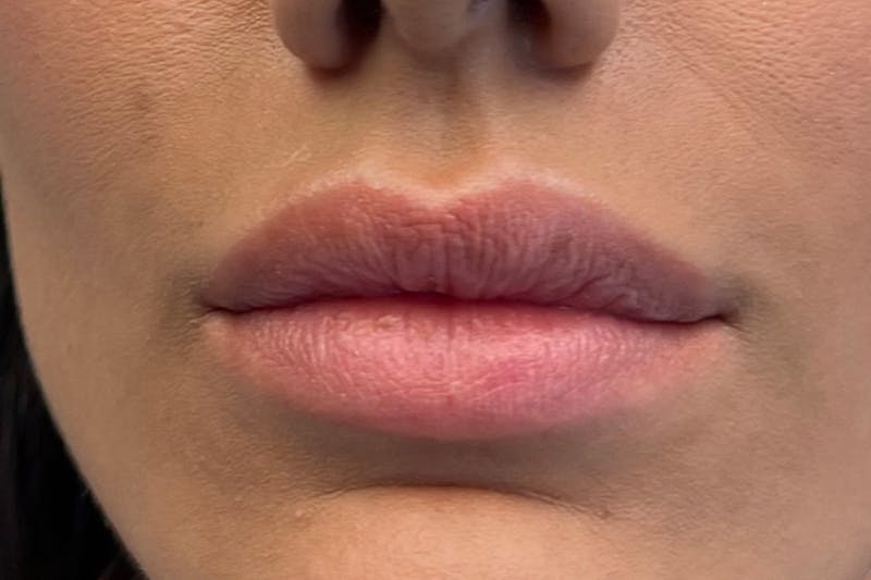Lip Filler Before & After Gallery - Patient 122948853 - Image 1