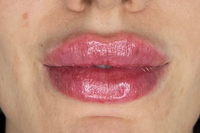 Lip Filler Before & After Gallery - Patient 122948853 - Image 2