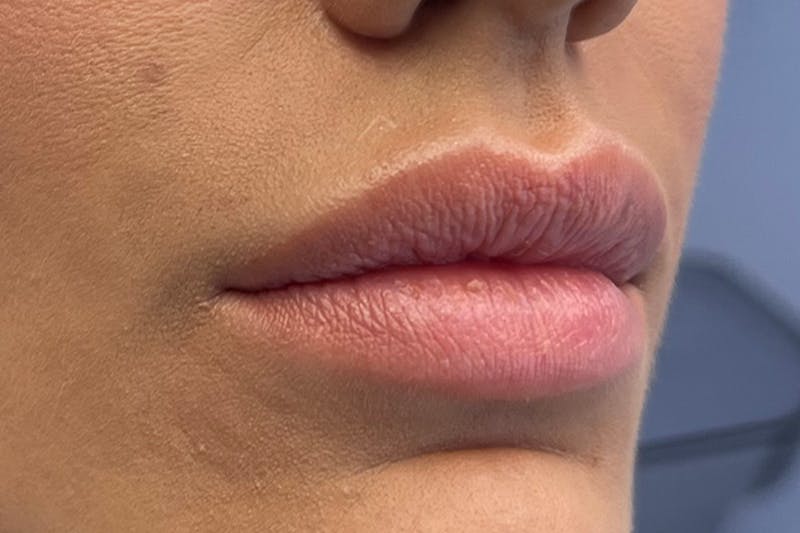 Lip Filler Before & After Gallery - Patient 122948853 - Image 3