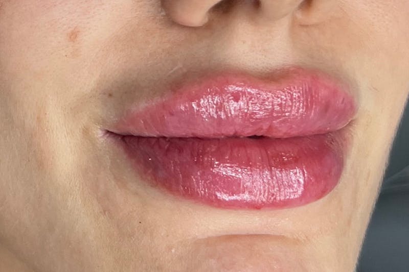 Lip Filler Before & After Gallery - Patient 122948853 - Image 4