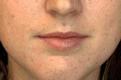 Lip Filler Before & After Gallery - Patient 122948868 - Image 1