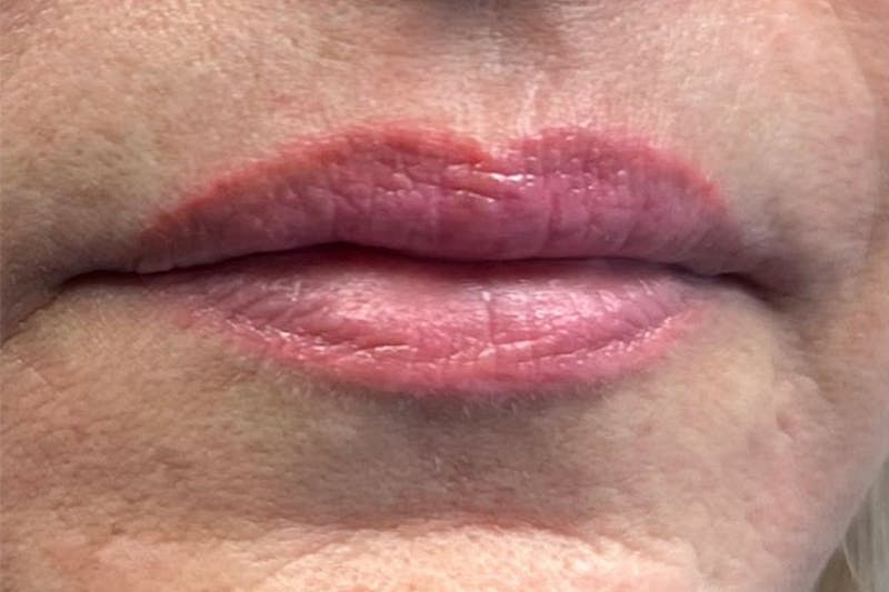 Lip Filler Before & After Gallery - Patient 122948879 - Image 1
