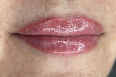 Lip Filler Before & After Gallery - Patient 122948879 - Image 2