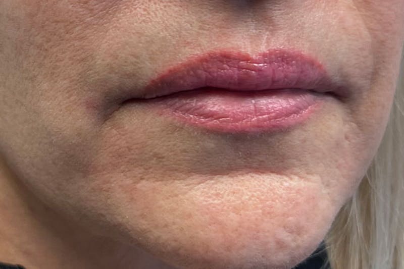Lip Filler Before & After Gallery - Patient 122948879 - Image 3