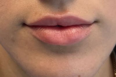 Lip Filler Before & After Gallery - Patient 122948902 - Image 1