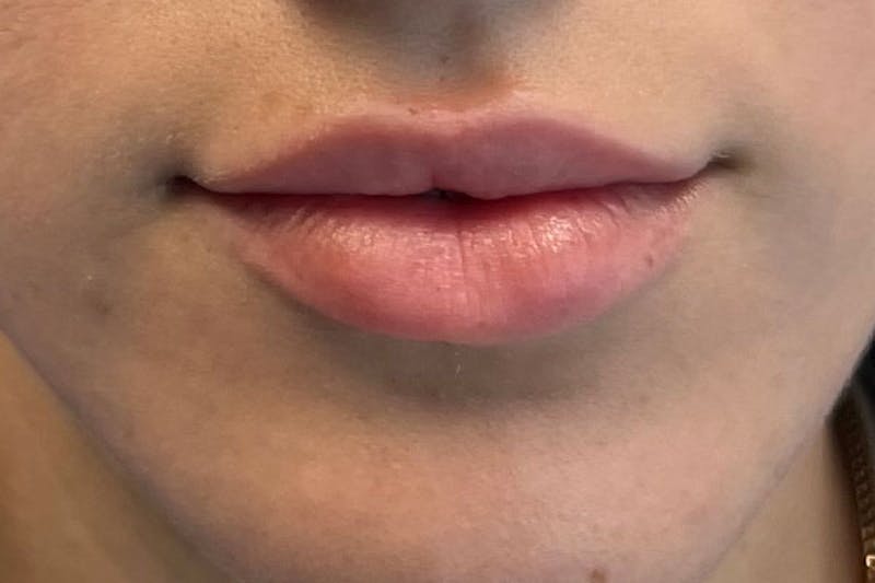 Lip Filler Before & After Gallery - Patient 122948902 - Image 1