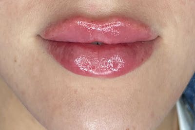 Lip Filler Before & After Gallery - Patient 122948902 - Image 2
