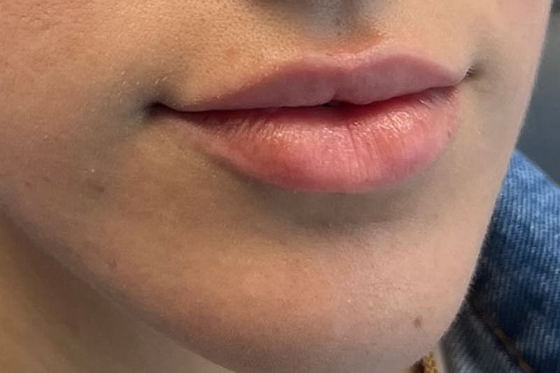 Lip Filler Before & After Gallery - Patient 122948902 - Image 3