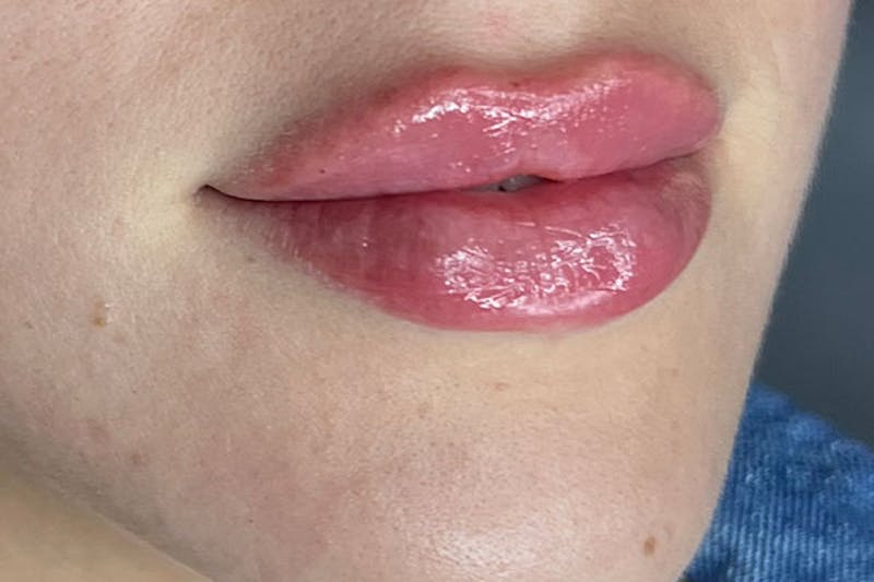 Lip Filler Before & After Gallery - Patient 122948902 - Image 4
