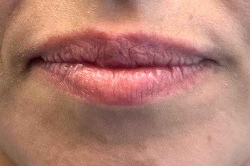 Lip Filler Before & After Gallery - Patient 122948912 - Image 1