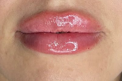 Lip Filler Before & After Gallery - Patient 122948912 - Image 2