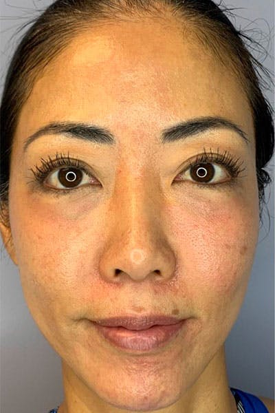 PRF/PRP Before & After Gallery - Patient 122948911 - Image 1