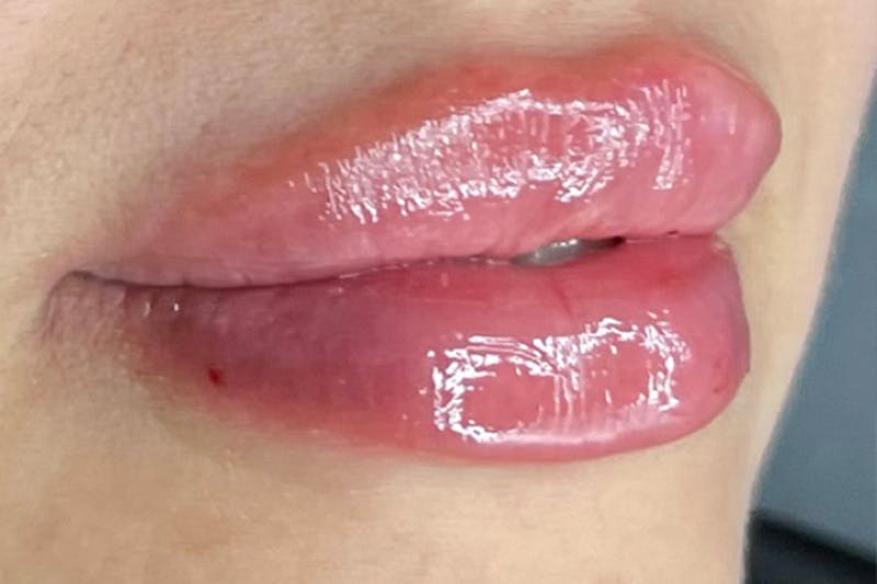 Lip Filler Before & After Gallery - Patient 122948912 - Image 4