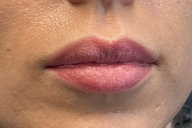 Lip Filler Before & After Gallery - Patient 122948929 - Image 1