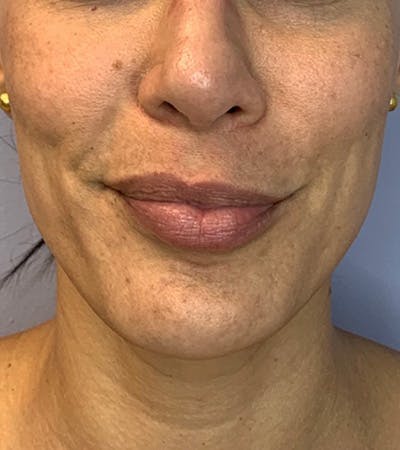 Skin Pen Microneedling Before & After Gallery - Patient 122948926 - Image 1