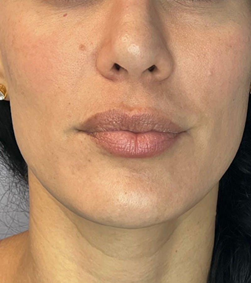 Skin Pen Microneedling Before & After Gallery - Patient 122948926 - Image 2