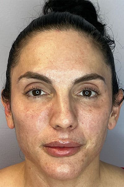 Skin Pen Microneedling Before & After Gallery - Patient 122948958 - Image 1