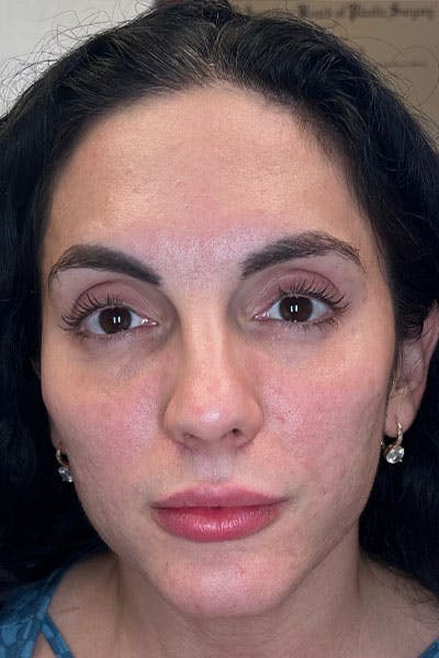 Skin Pen Microneedling Before & After Gallery - Patient 122948958 - Image 2