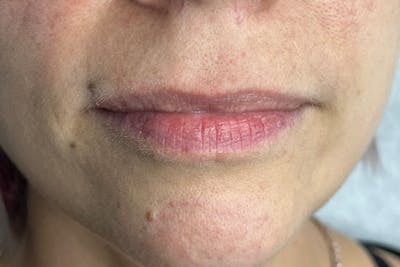 Lip Filler Before & After Gallery - Patient 122948948 - Image 1